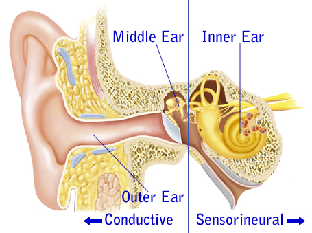 About Deafness
